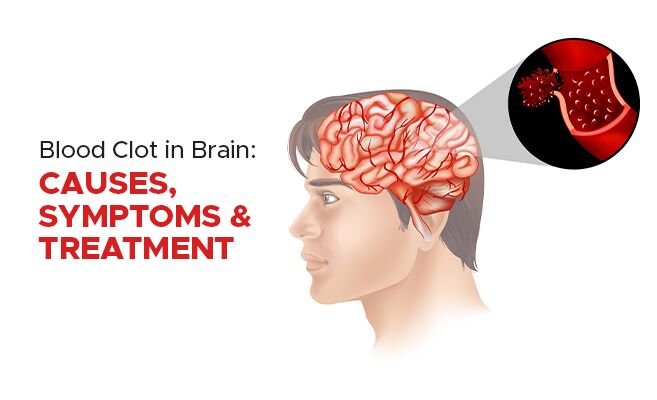 Blood Clot in Brain: Reason, Causes, Symptoms & Treatment