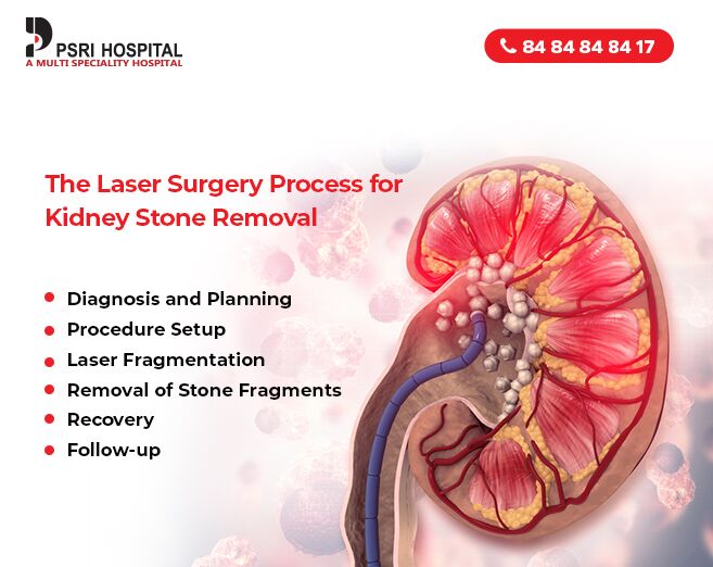 kidney stones treatment